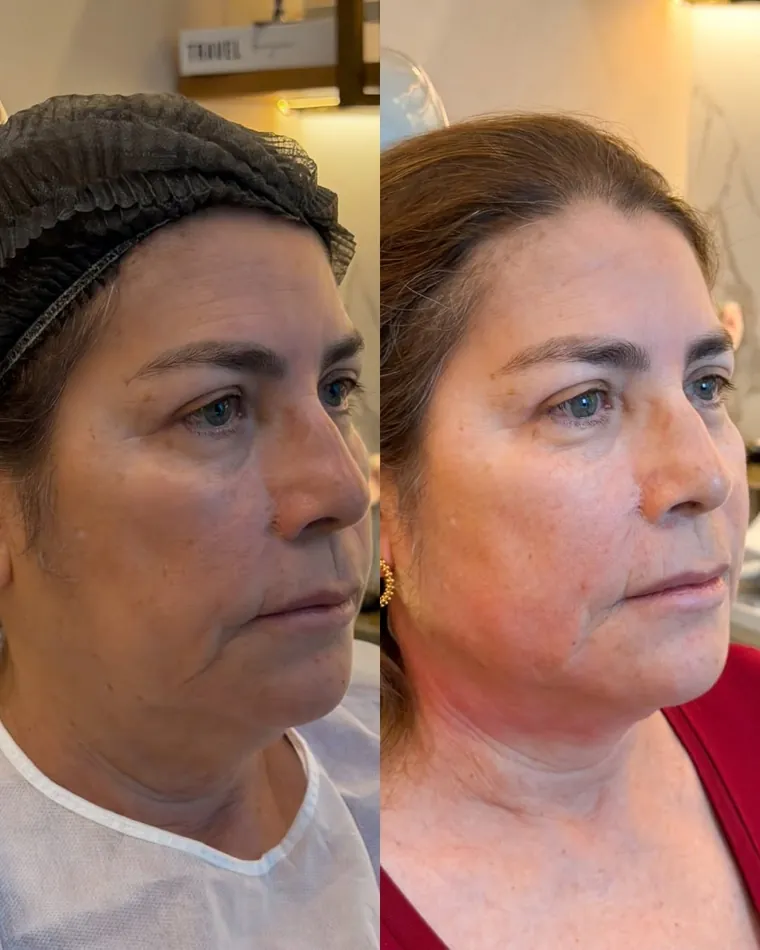 Antes e depois com fios de sustentação